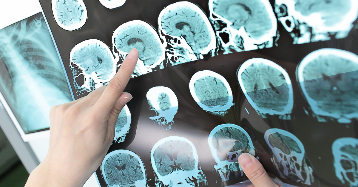 İnme tedavisinde 4.5 saat kuralı!