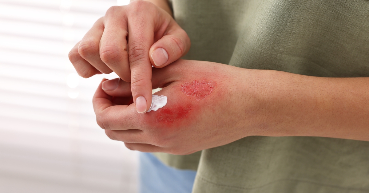 “Yanığın üzerine yağ, diş macunu, zeytin sürmeyin” uyarısı